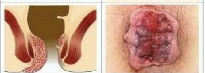 <p>Which grade of internal hemorrhoids has pain, bleeding, swelling, and staining/soilage with mucous or feces and on exam you find grossly evident prolapse that is <strong>non-reduceable</strong>?</p>