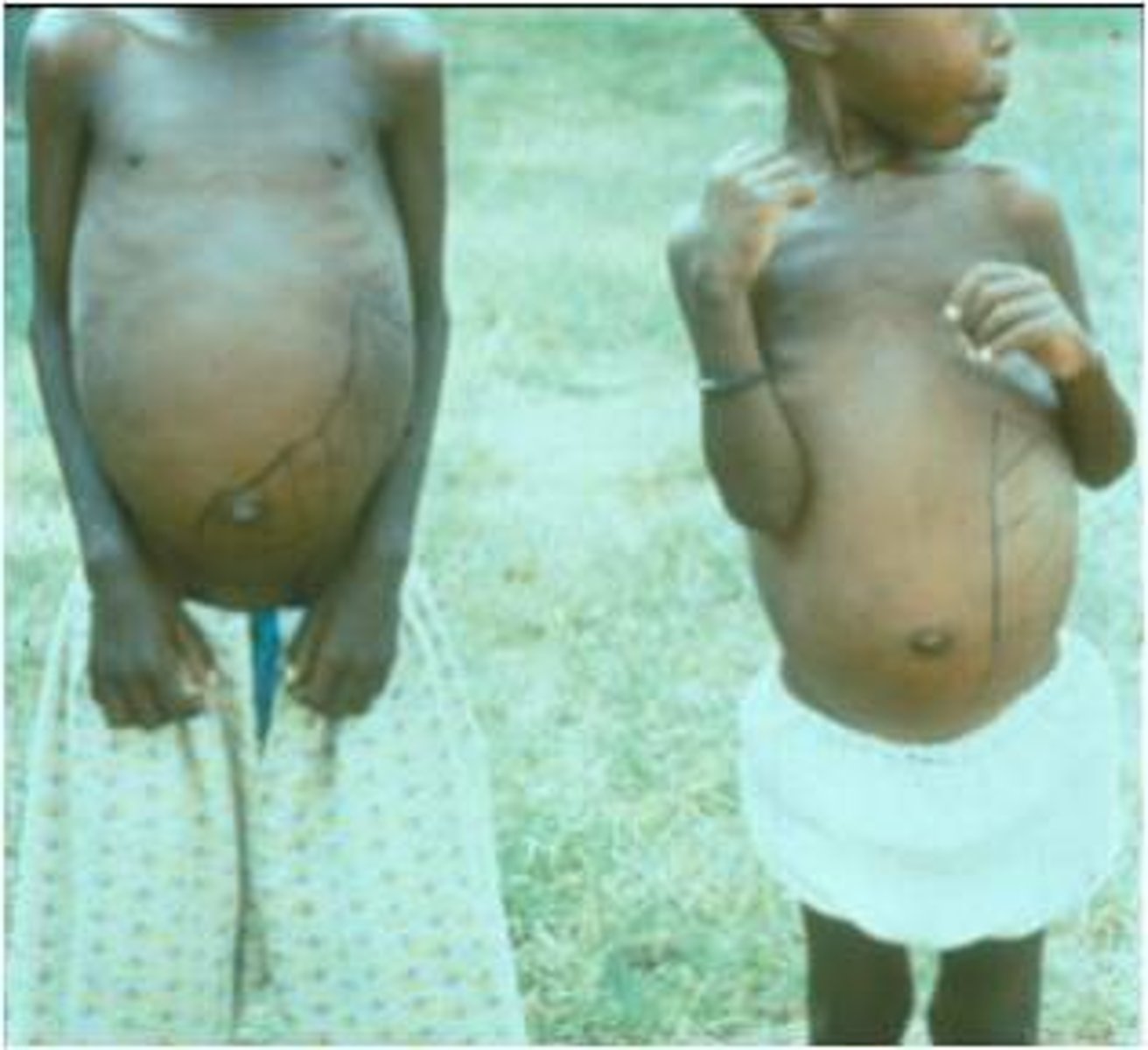 <p>•Parasites spread hematogenously to cells in liver, spleen, bone marrow, intestinal lymph nodes</p>