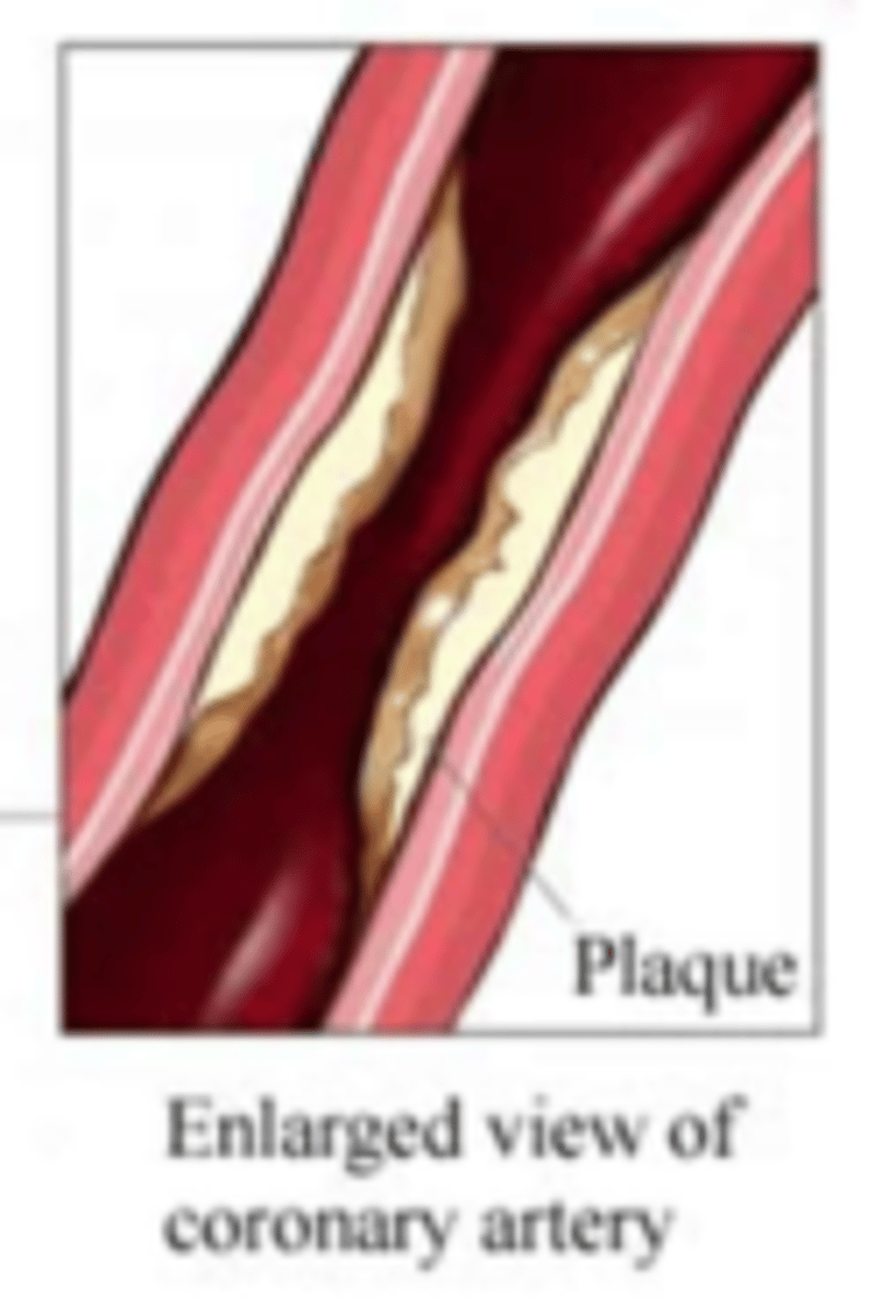 <p>atherosclerotic plaque in vessel wall</p><p>- limited blood flow to the heart so less O2 to the myocardium → coronary artery ischemia</p>