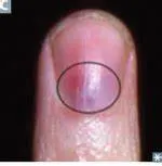 <p><strong>Is a glomus angioma a vascular tumor?</strong></p><ul><li><p><strong>a) yes</strong></p></li><li><p>b) no</p><ul><li><p>A glomus tumor or glomangioma is a&nbsp;<strong>rare, benign growth of blood vessels</strong>&nbsp;which can develop in both adults and children. Glomus tumors can develop as a solitary glomangioma (one growth of blood vessels) or as multiple glomuvenous formations (multiple groupings of blood vessels)</p></li></ul></li></ul><p></p>