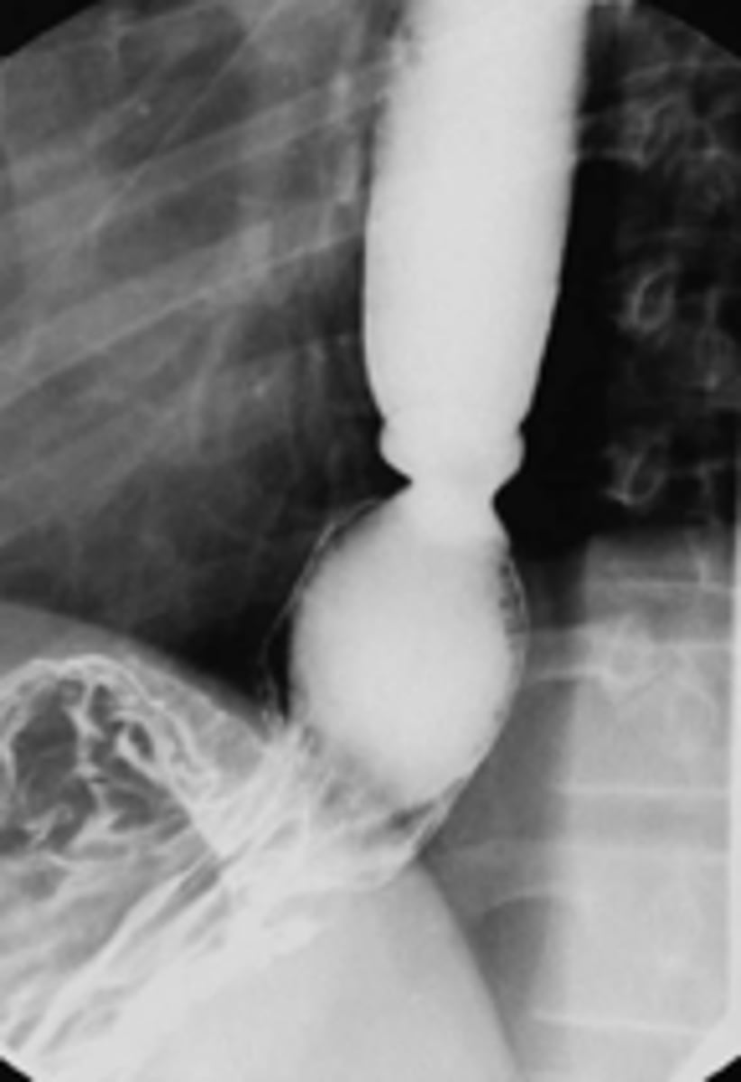 <p>patient presents with dysphagia of large solid foods (steakhouse syndrome). An endoscopy is performed and a narrowing of the distal esophagus is observed. What is the diagnosis?</p>