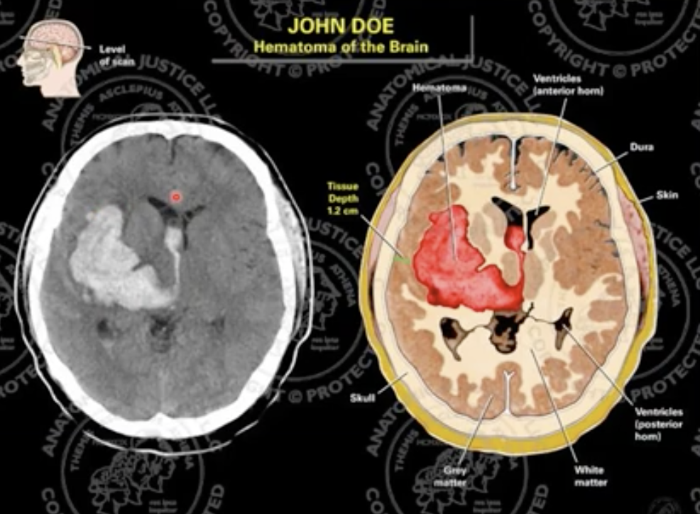 **Intraparenchymal** 

causes fast increase in intracranial pressure, 80% mortality rate. 

caused by **hypertension**, blood thinners / anticoagulants, trauma 