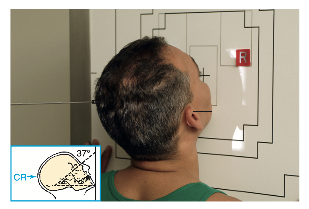 <p>What <u>lines</u> are used for <strong>Parietocanthial projection: Waters method </strong>for <strong>sinuses?</strong></p>