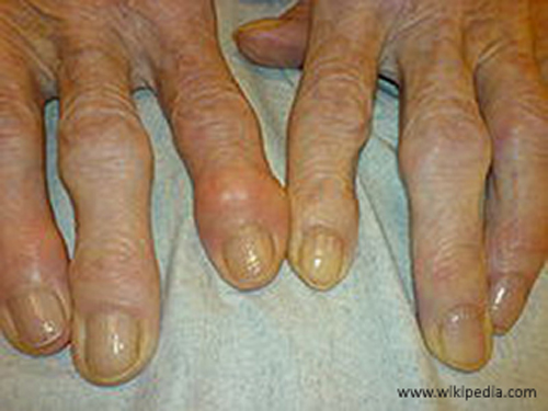 <p><span>a result of osteophyte formation of the bones, which give the hands a bumpy external appearance</span></p>
