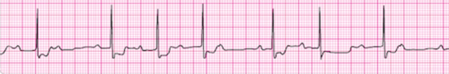 <p>Identify the rhythm.</p>