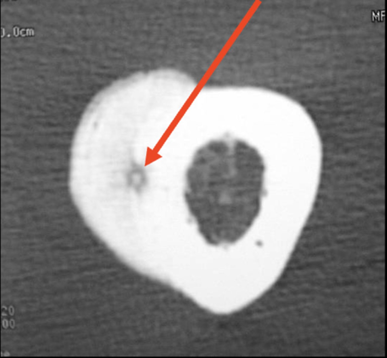<p>ID radiographic feature of osteoid osteoma</p>