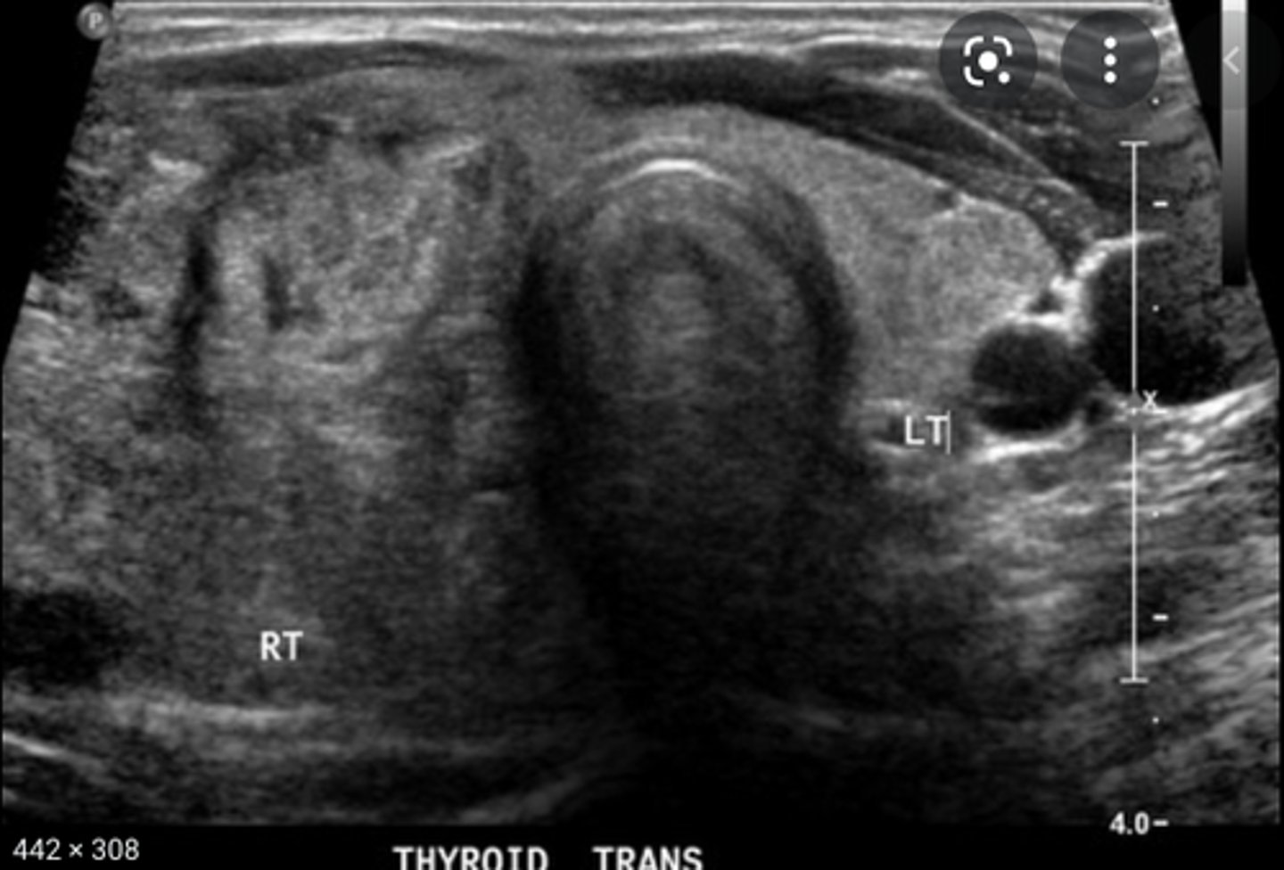 <p>Etiology</p><p>-Thyroid hormone deficiency</p><p>-Iodine deficiency</p><p>-Graves' disease</p><p>-Thyroiditis</p><p>Clinical findings</p><p>-Palpable neck mass</p><p>-Dysphagia</p><p>-Dyspnea </p><p>-Hyperthyroidism or hypothyroidism</p><p>Sonographic findings</p><p>-Enlarged thyroid lobe(s)</p><p>-Diffusely heterogeneous</p><p>-Areas of cystic degeneration</p><p>-May demonstrate calcification(s) </p>