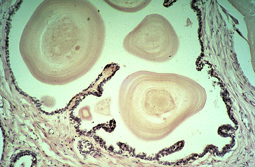 <p><strong>Prostate</strong></p><ul><li><p class=""><strong>Multiple glands</strong></p></li><li><p class="">Thin &amp; flat epithelium (older individual)</p></li><li><p class=""><strong>Corpora amylacea</strong> (round, eosinophilic concretions) often seen in gland lumens. Multiple layers over time</p></li></ul><p></p>