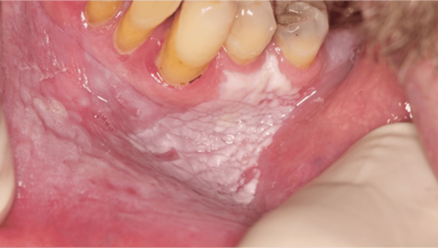 <p>corrugated/wrinkled vestibule</p><p>• smokeless tobacco use</p><p>• biopsy if ulcerated or doesn't heal in 14 days after movement of tobacco </p>