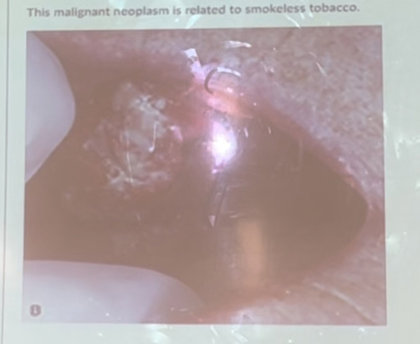 <p>This malignant neoplasm is related to smokeless tobacco</p>