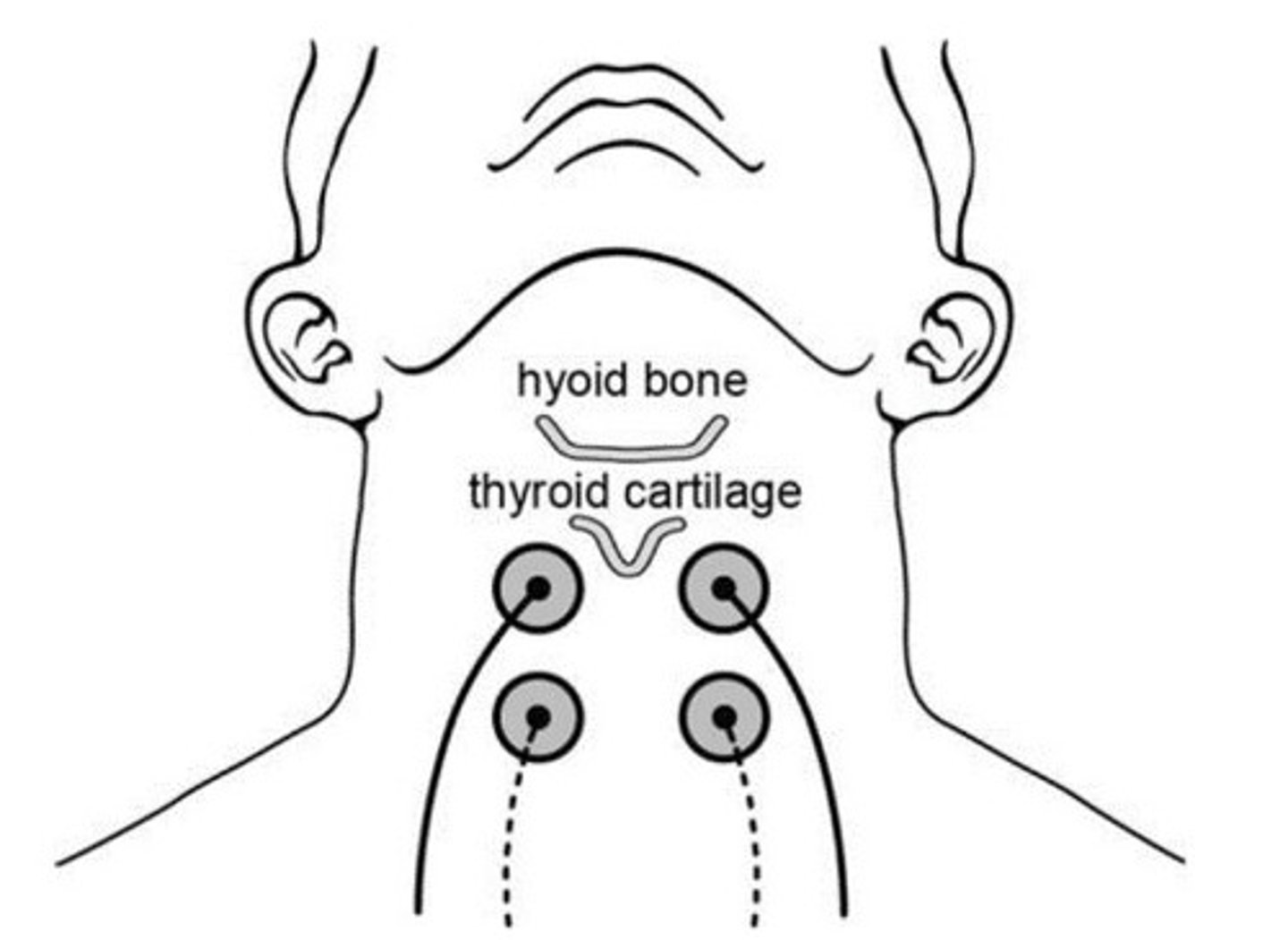 <p>Short-term decrease, followed by a long-term increase in hyolaryngeal excursion.</p>