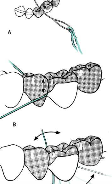 <p>Dental floss threader</p>