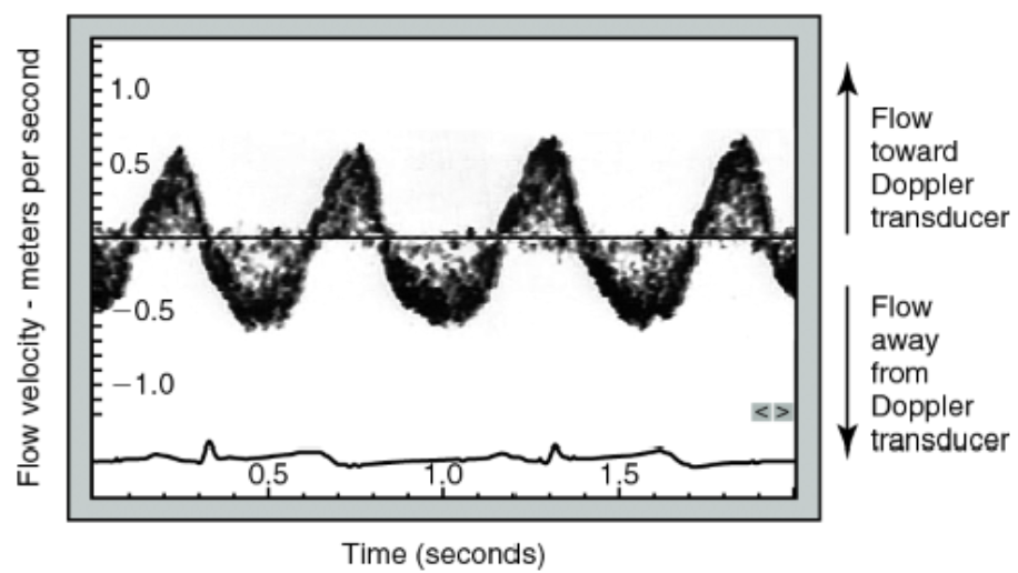 <p>is a graphical representation of blood flow velocity over time, generated by an ultrasound machine</p>