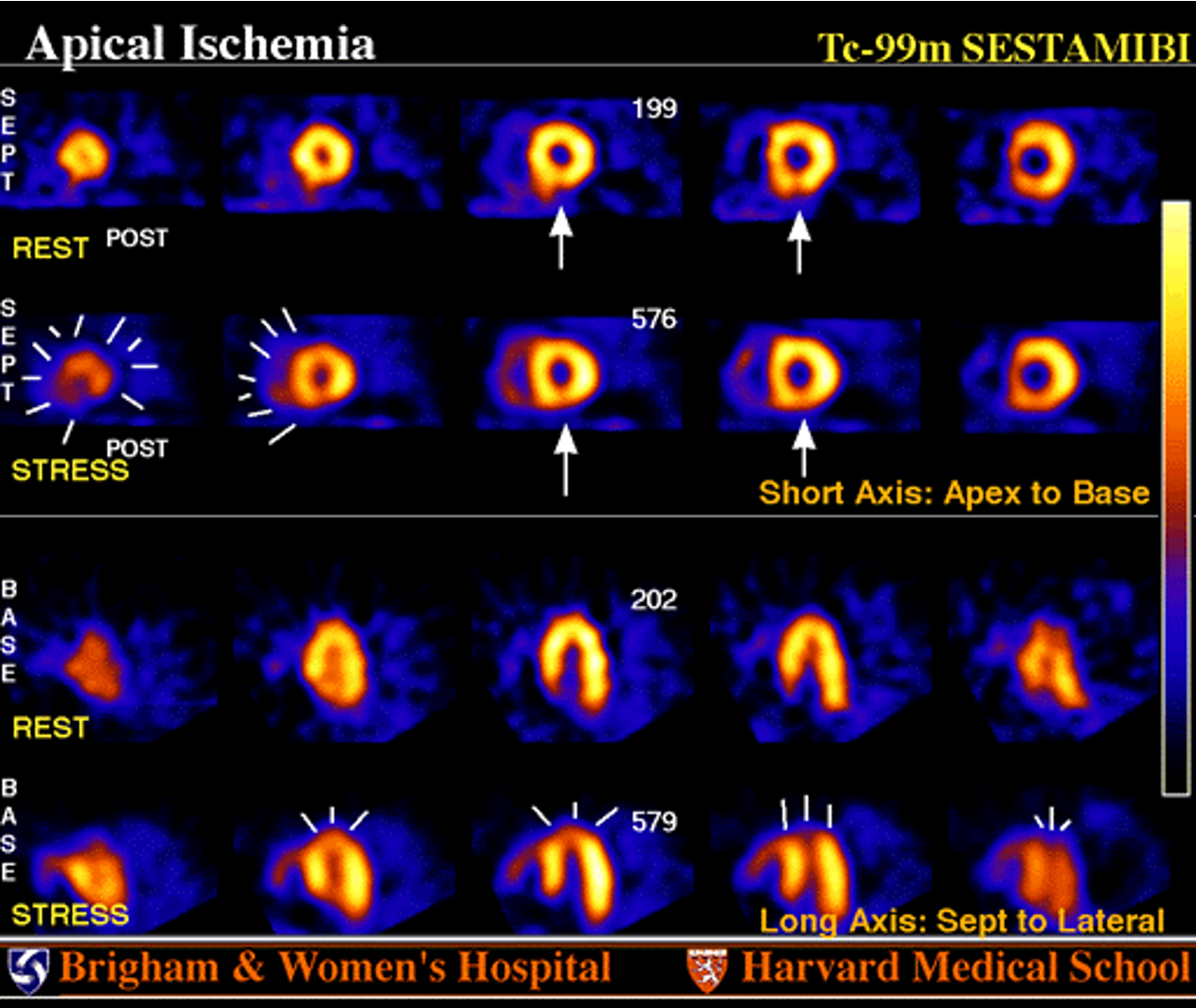<p>The reversible apical and septal defect corresponds to which coronary artery?</p>