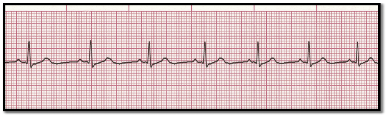 <p>What is the rhythm?</p>