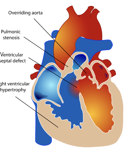 <p>Heart doesn’t develop correctly, causes hole in ventricular system (septal defects), pulmonary stenosis, ventricular hypotrophy (thicker myocardial mass), and shift of aorta</p>