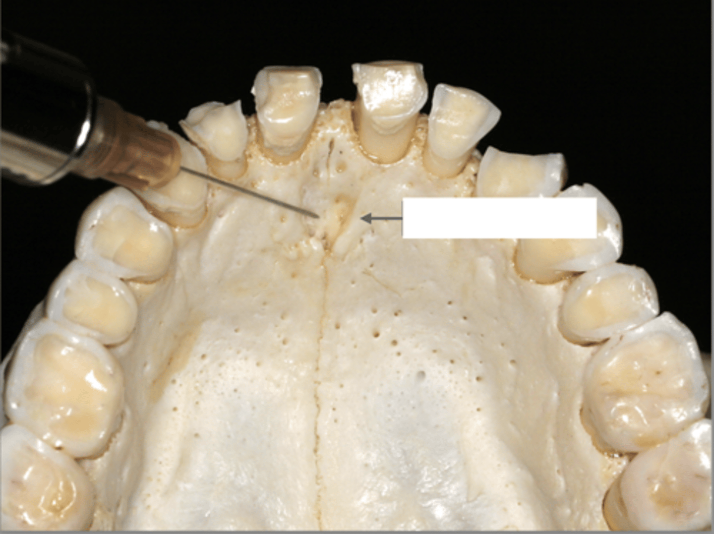 <p>Which type of injection and what is the arrow pointing to as a landmark?</p>
