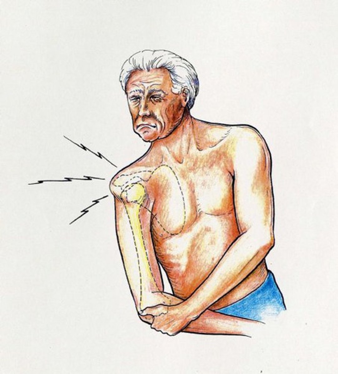 <p>injury in which a bone has been forced out of its normal position in a joint</p>