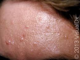 <p><span>A proliferation of cells which is reactive and not neoplastic. In some cases, this may be a result of the body's normal reaction to an imbalance or other stimulus, while in other cases the physiologic cause of the proliferation is not apparent. An example of the former process is the enlargement of lymph nodes in the neck as a result of reaction to a bacterial throat infection.</span></p>