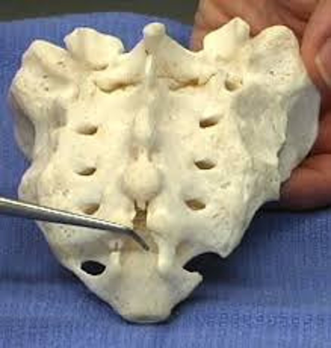 <p>Opening at inferior end of sacrum on posterior side</p><p>Used as a route to administer an epidural anesthetic</p>