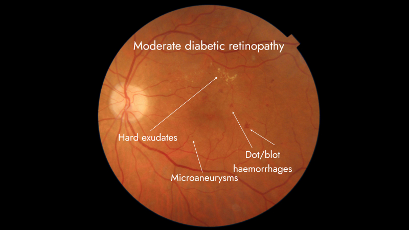 <p>small, round, superficial hemorrhages that originate from the superficial capillary network of the retina</p>