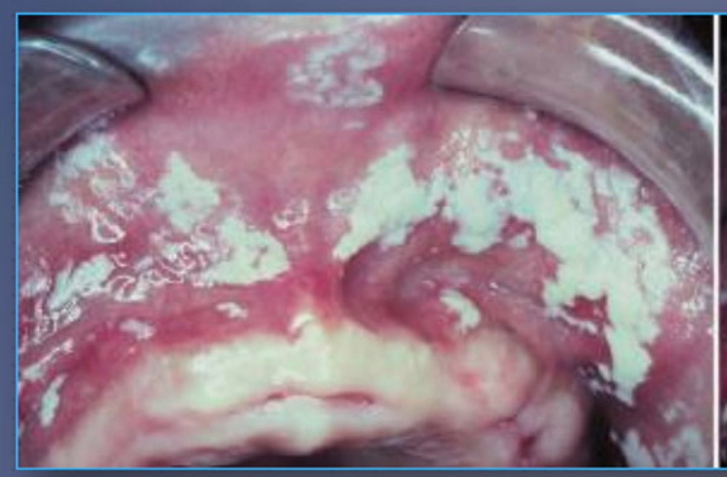 <p>cheesy white plaques that wipe off</p><p>• leaves red, tender surface</p><p>• no bleeding</p>