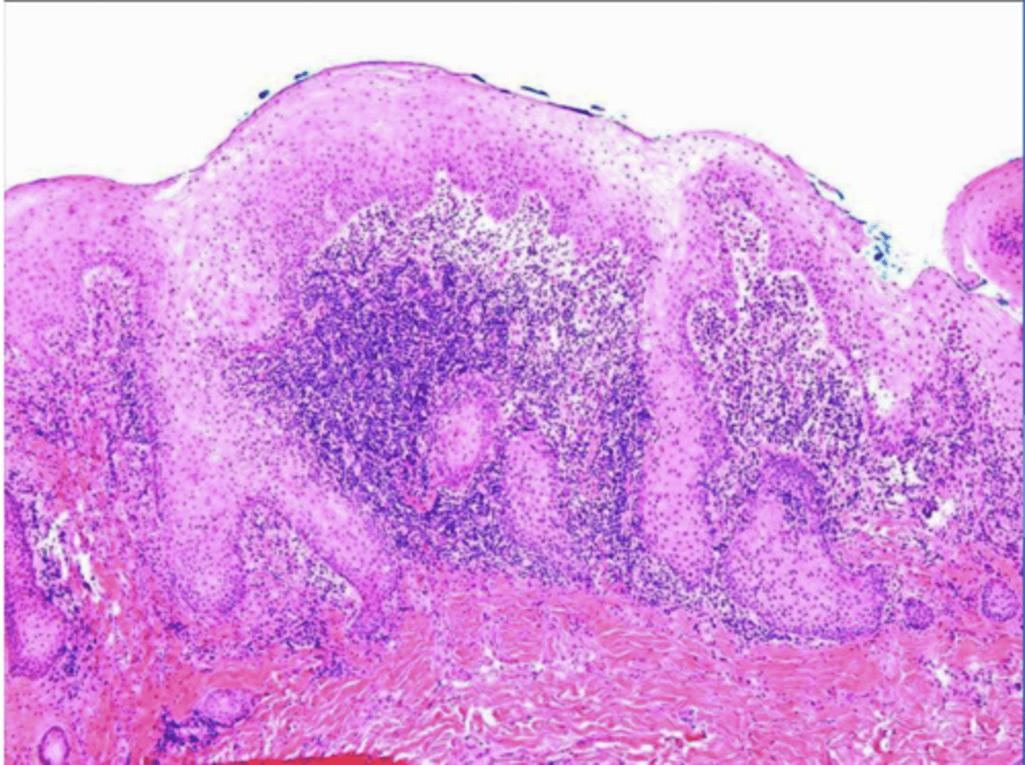 <p>why can an histological image of pseudoepithliomatous hyperplasia be mistakenly diagnosed as squamous cell carcinoma?</p>