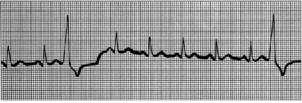 <p><span><span>Occasional irregular beat <br>(d/t ventricular signaling)</span></span></p>