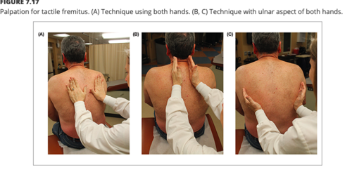 <p><u>process</u></p><ol><li><p>use ulnar surface of hand</p></li><li><p>ask pt to put hands on hips</p></li><li><p>ask pt to say+repeat “99”</p></li></ol><p><u>3 anterior lung field positions</u></p><ul><li><p>2 mid-clavicular</p></li><li><p>1 lower anterior axillary line region</p></li></ul><p><u>4 posterior lung field positions</u></p><ul><li><p>3 mid-scapular line</p></li><li><p>1 lower posterior axillary line region</p></li></ul><p><u>increased fremitus→enhances the transmission of vibration</u></p><ul><li><p>consolidated tissue</p></li><li><p>inflammation around a lung abscess</p></li></ul><p><u>decreased/absent fremitus→obstruction of transmission of vibration</u></p><p>DX:</p><ul><li><p>thickened pleurae</p></li><li><p>pleural effusion</p></li><li><p>pneumothorax tumor</p></li></ul><p></p>