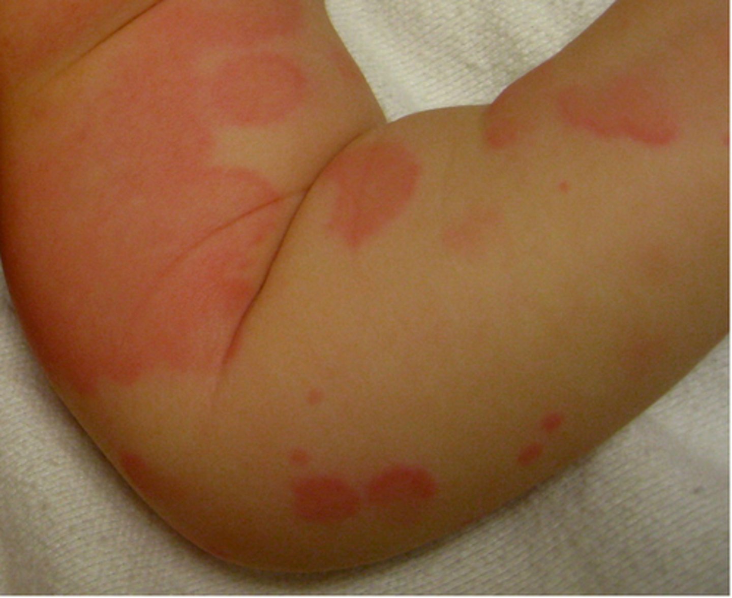 <p>urticarial eruptions PLUS fever, rash, and arthralgias with NO IMMUNE INVOLVEMENT</p>