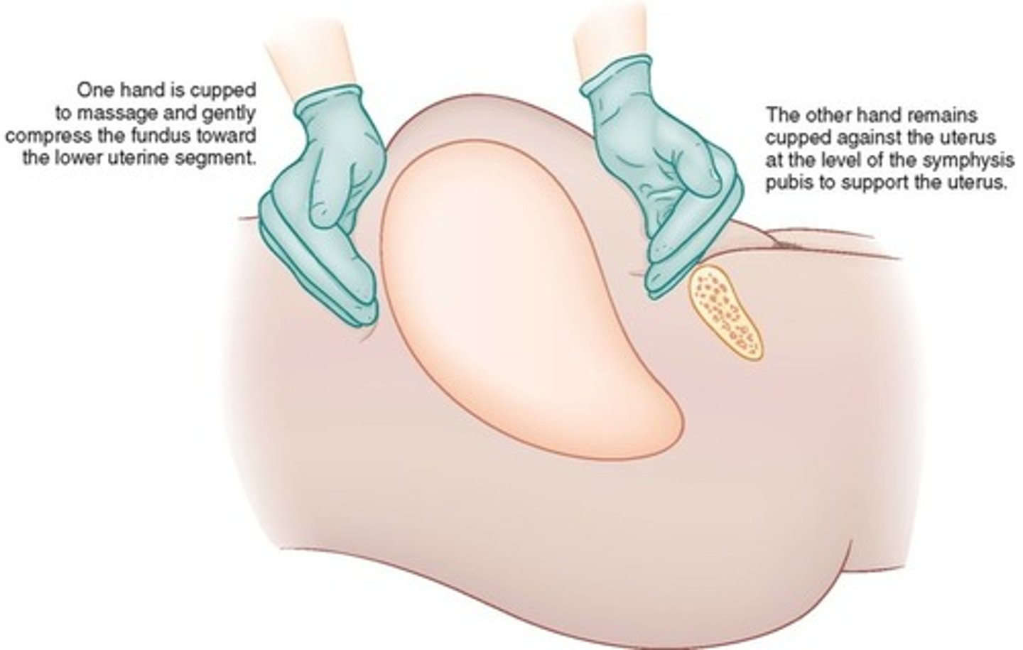 <p>Clinical manifestations:</p><p>Boggy uterus</p><p>Heavy bleeding</p><p>Confirmed by bimanual exam</p><p>Prevention:</p><p>Recognizing risk factors</p><p>Initiating early intervention and treatment</p>