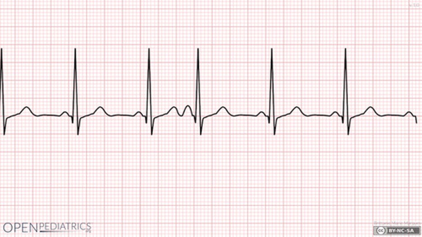 <p>Early atrial beat where the p wave is of a different morphology than the rest</p>