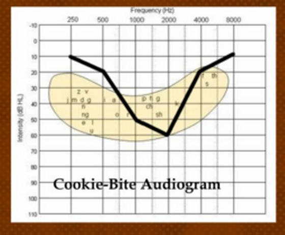 <p>when the hearing loss is normal at both ends and the loss is in the mid pitches only</p>