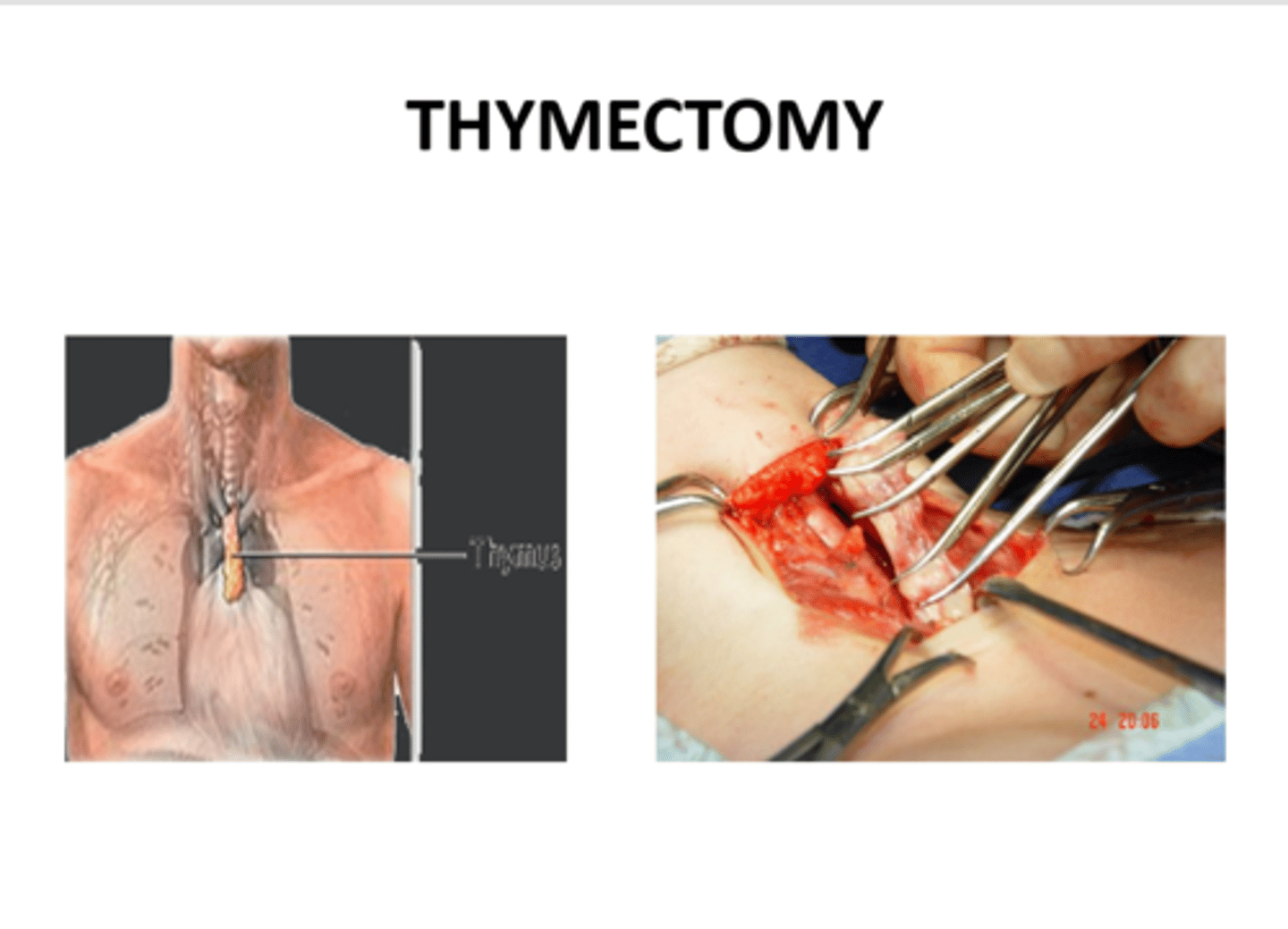 <p>Where should the sternotomy be carried in a thymectomy procedure?<br>- For patients with myasthenia gravis and thymoma</p>