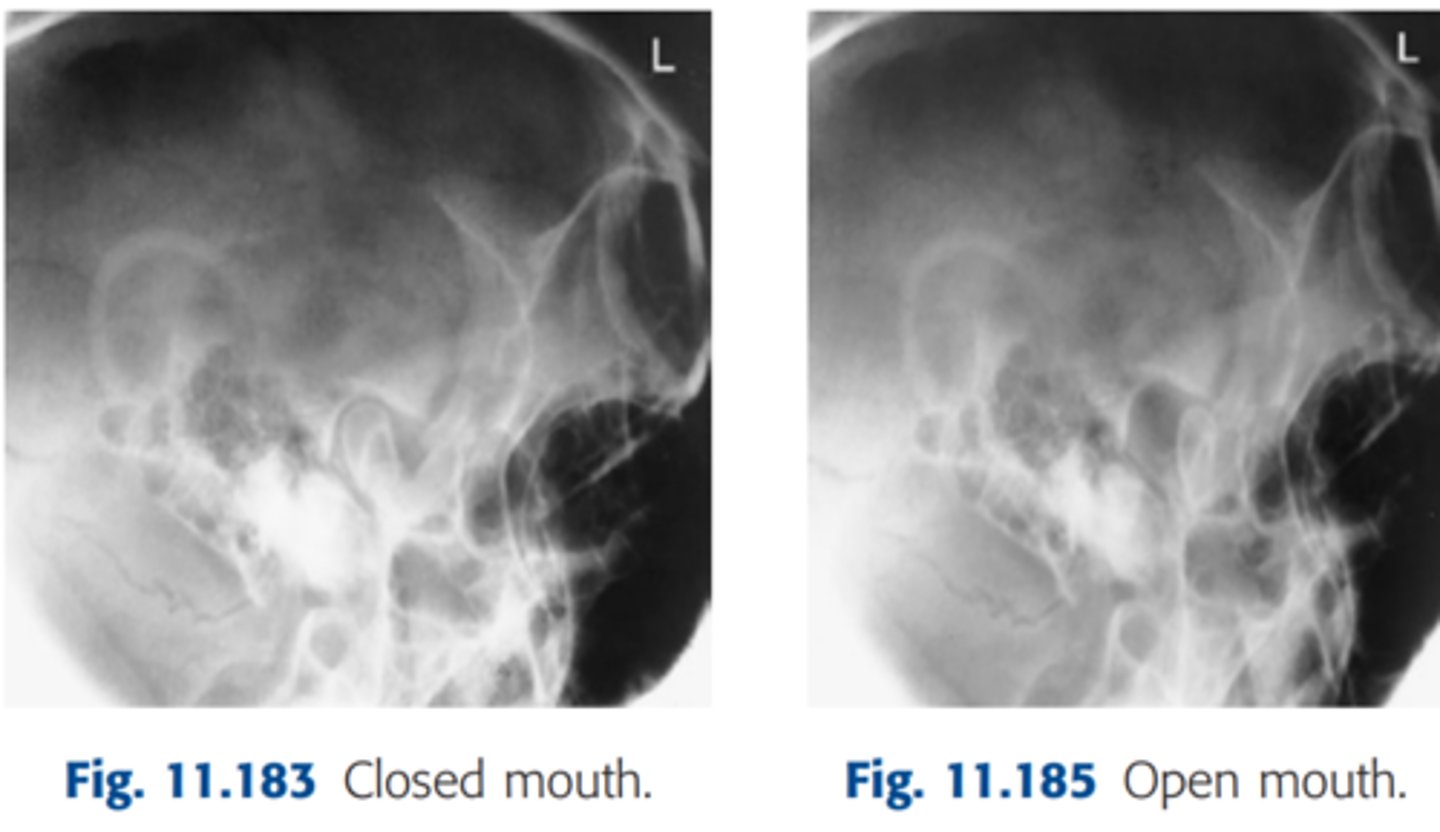 <p>-Position: TMJs are demonstrated without rotation, as evidenced by superimposed lateral margins</p>