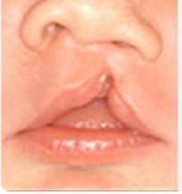 <p>cleft lip that does not involve the nose</p>