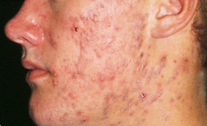 <p>What are the risk factor of having Acne Vulgaris?</p>