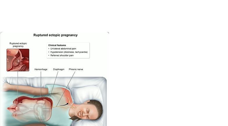 <p>what are interventions for an ectopic pregnancy?</p>