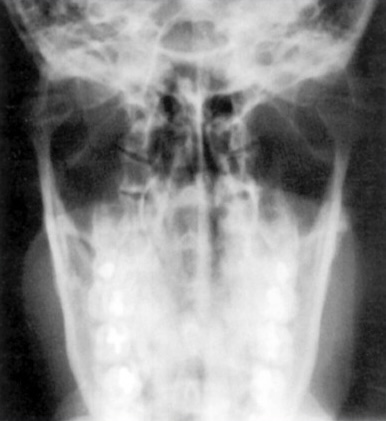 <p>What is this x-ray demonstrating?</p>