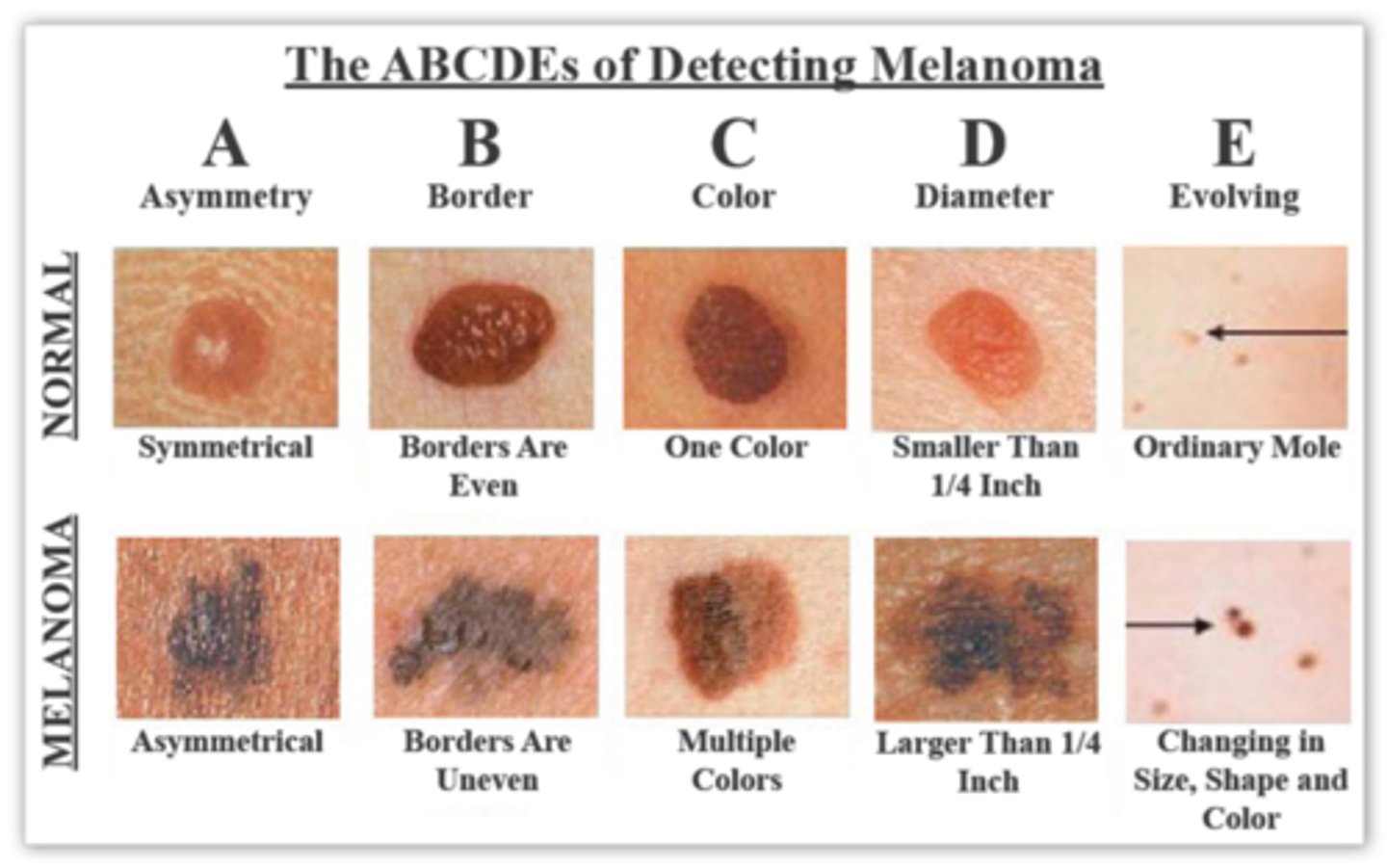 <p>ABCDE of melanoma detection:</p><p>Asymmetry, Border irregularity, Color, Diameter of more than 6mm, Evolution of lesion over time</p>