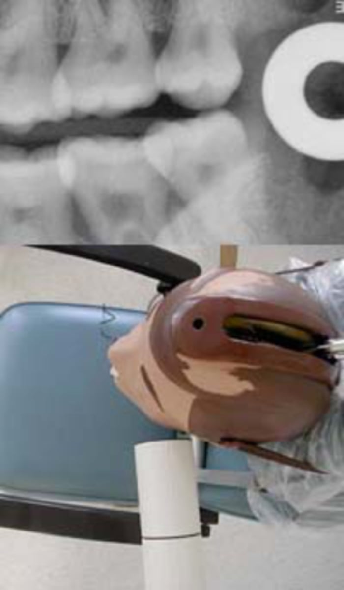 <p>-The x-ray beam is directed obliquely from distal to mesial</p><p>Cause - If overlapping is more in the anterior region, cone is angled too much from the distal</p><p>Correction - Shift the PID toward the anterior, direct the central ray beam more from the mesail</p>