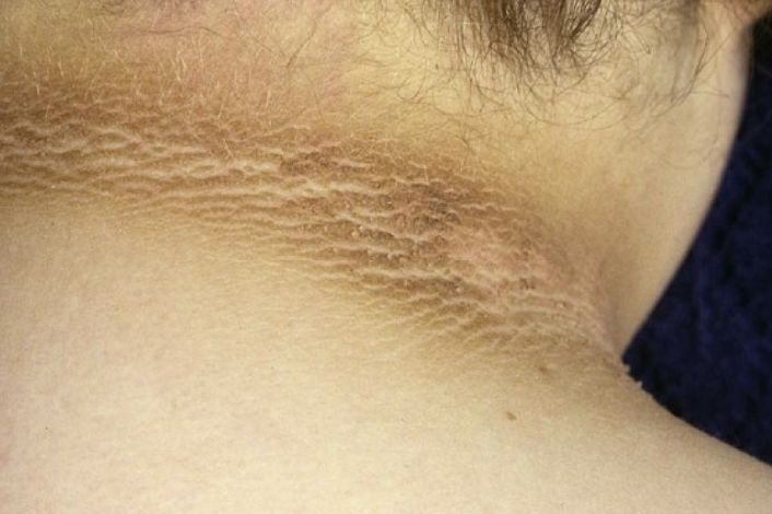 <p>Abnormal Skin Pigmentation Finding</p><ul><li><p><strong>Roughening</strong> and <strong>darkening</strong> of skin in localized areas, especially the posterior neck</p></li><li><p>Suggests<strong> diabetes mellitus </strong>or<strong> PCOS</strong></p></li></ul><p></p>