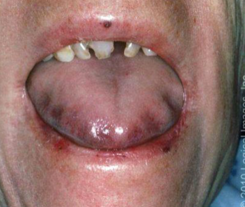 <p>abnormally large tongue, often associated with conditions such as Down syndrome </p>