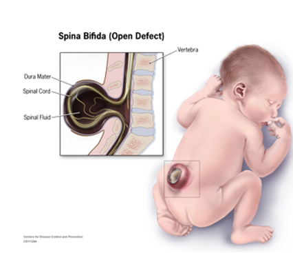 <ul><li><p>failure of fusion of neural tube results in neural tube defects of the tissue overlying the spinal cord</p></li><li><p>characterized by defects in vertebral arches and various degrees of disability</p></li></ul><p></p>