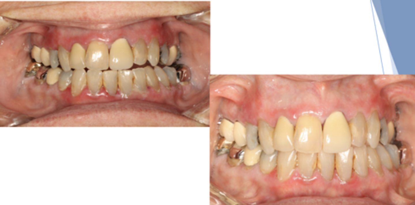 <p>Patient presents with an autoimmune disorder with autoantibodies to hemidesmosomes. What condition do you suspect?</p>