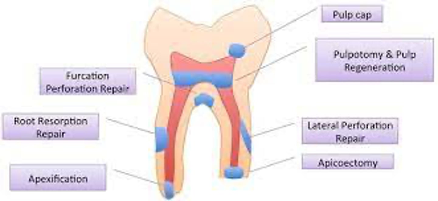 <p>_____ is superior to ZOE, calcium hydroxide &amp; formocresol – MTA is the gold standard. </p><p>Use for pulpotomies, pulp capping, liner/base</p>