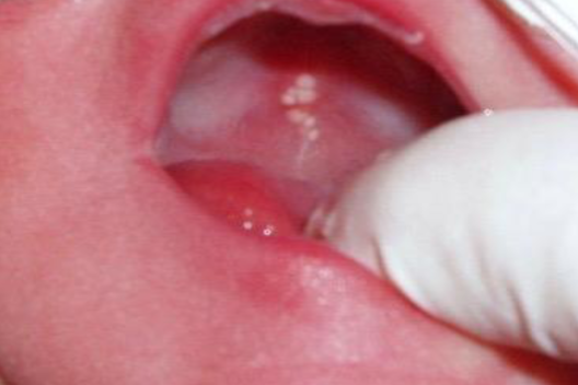 <p>small, white cysts along MEDIAN PALATAL raphe</p>