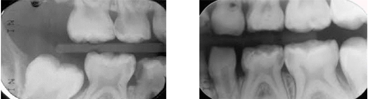 <p>how many lesion are there</p>