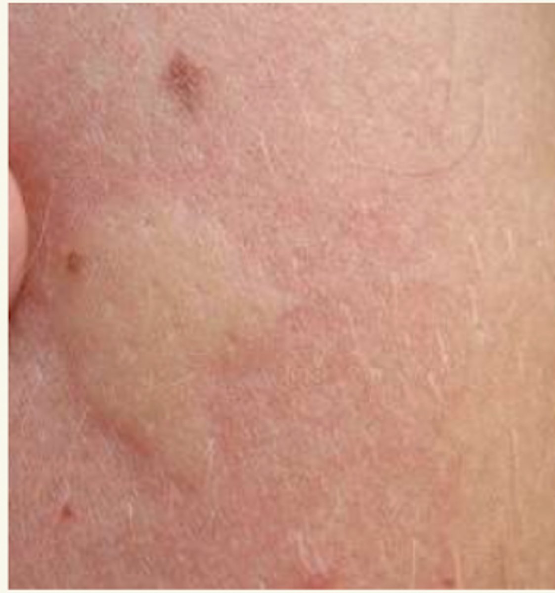 <p>¿lesión?</p><p>¿primaria o secundaria?</p>