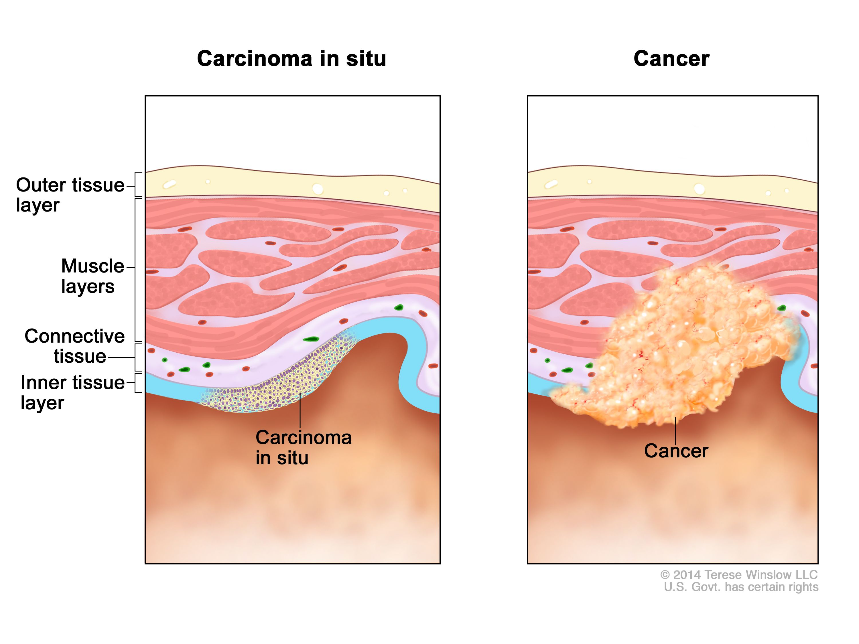 <ol><li><p>Epithelial in origin</p></li><li><p><span style="color: blue"><strong><em><u>Morphologically similar to cancer </u></em></strong></span></p></li><li><p>Non-invasive (premalignant lesion)</p></li></ol><p></p>